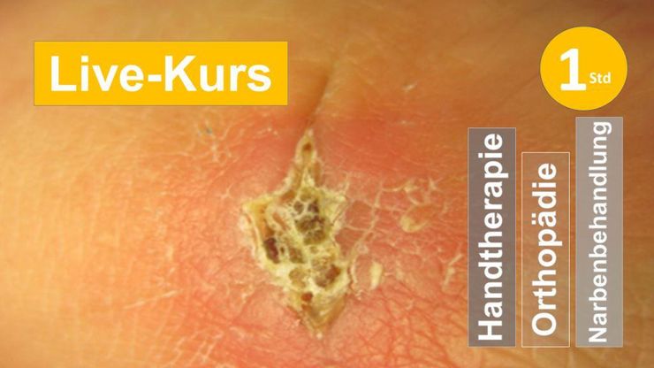Sie sehen eine unregelmäßige krustig verheilte Wunde als Symbol für ein Webseminar für Ergotherapie + Physiotherapie in der Rehabilitation von Wunden + Narben im Zusammenhang mit Mechanismen der Wundheilung in der Handreha + Orthopädie in Klinik + Praxis