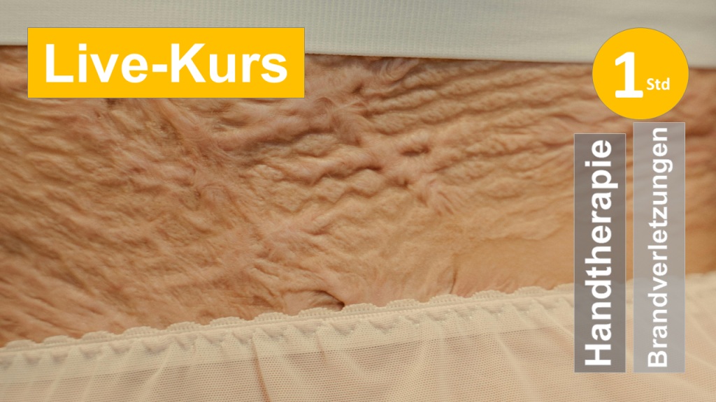 Sie eine hauttransplantierte Narbenfläche am Bauch, als Assoziation zum Webseminar über Frühkompression bei Brandverletzungen und  Verbrennungen für Ergotherapie und Handtherapie in der HandReha, SchmerzReha und Narbenbehandlung in Klinik + Praxis