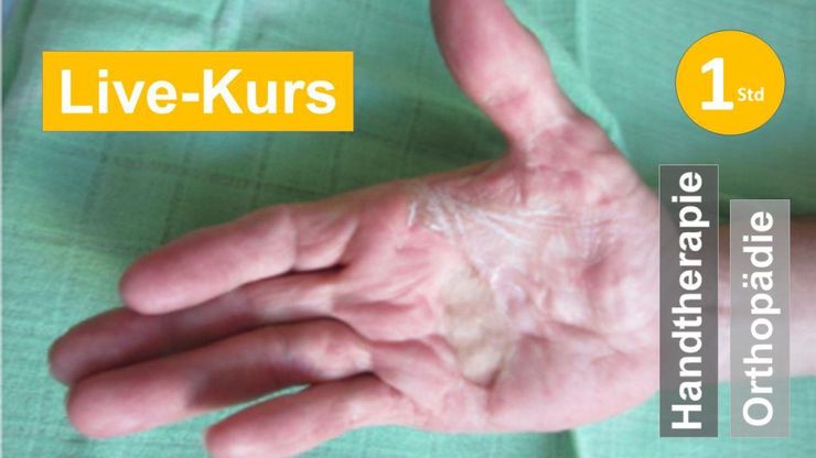 Sie sehen eine Handfläche von innen mit Dupuytren-Symptomatik als Assoziation zum Webseminar für prä- und postoperative Ergotherapie + Physiotherapie in der Rehabilitation von Marbus Dupuytren in der handreha + Orthopädie in Klinik + Praxis
