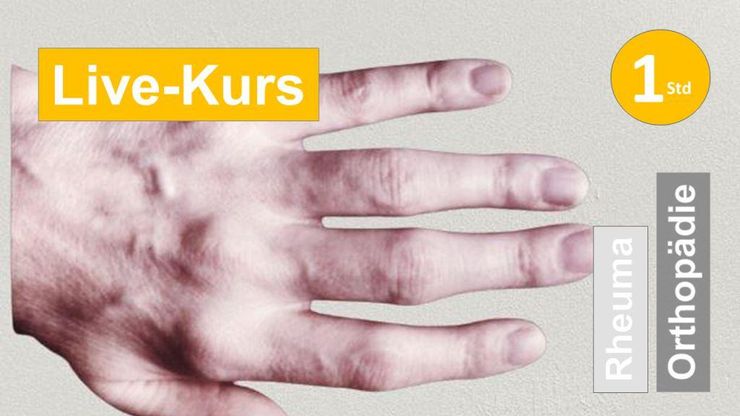 Sie sehen eine Hand mit verdickten Metacarpalgelenken und proximalen Fingergelenken als Assoziation zum Webseminar für Ergotherapie + Physiotherapie in der Rehabilitation Rheuma  + von Erkrankungen im polyartthritischen Formenkreis in Klinik + Praxis